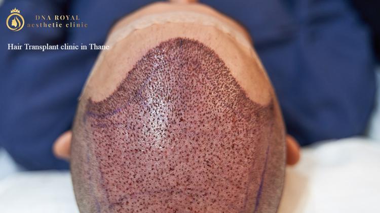 Hair transpant clinic